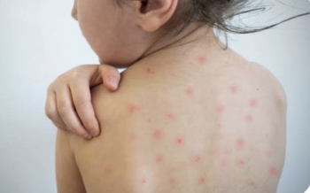 México acumula 44 defunciones y 18 mil 768 casos de sarampión